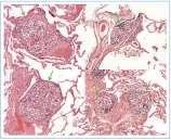 2. Erkrankungen des Herzmuskels Sarkoidose Knötchen bildende entzündliche Erkrankung, welche vorrangig die