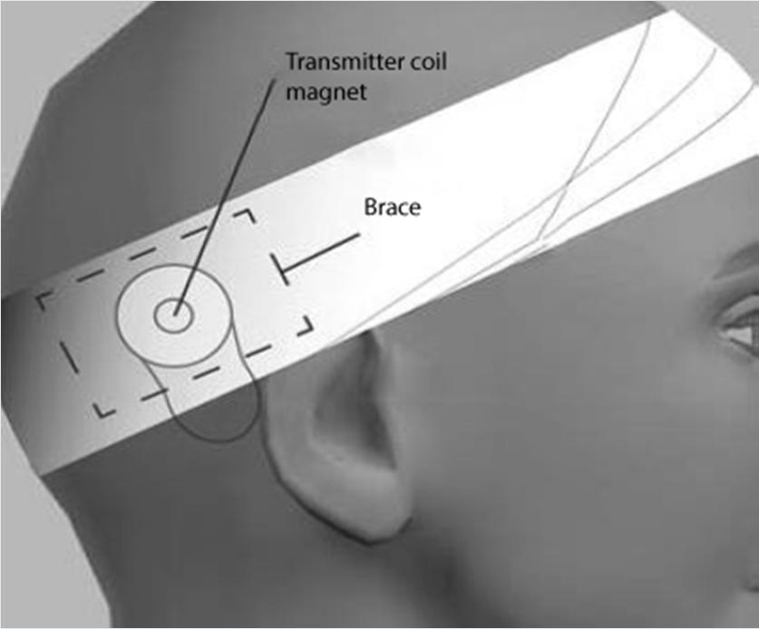 MRI und Cochlea Implantat Vorsichtsmassnahmen - Magnetstärke entscheidend, meist nur 1.5 Tesla und nicht 3.0 Tesla möglich.