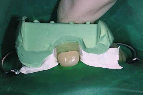 der Kollaps des Kollagengeflechts lässt sich teilweise wieder rückgängig machen, indem das Dentin mit einem angefeuchteten Microbrush wieder befeuchtet wird (Rewetting).