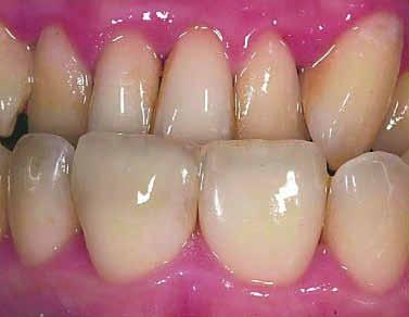 9: Fallbeispiel Seitenzahnrestauration: Ein 24-jähriger Patient stellt sich mit latenten Beschwerden an den Zähnen 35 und 36 vor. Diese weisen insuffiziente Glasionomer-Restaurationen auf.