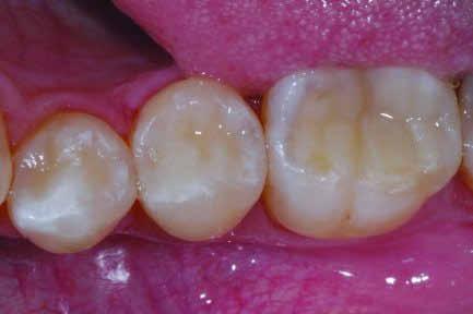 Es erfolgt zunächst eine Ätzung des Schmelzes für 30 Sekunden und des Dentins für max. 15 Sekunden mit 35-prozentiger Phosphorsäure (Vococid, Voco).
