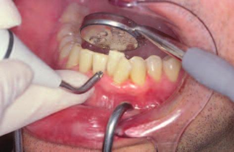Es wird geschaut, ob und wo Beläge vorhanden sind, ob das Zahnfleisch blutet und ob Zahnfleischtaschen vorhanden sind.