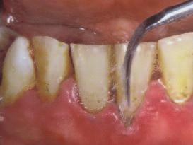 Sie hat das Ziel, alle krankmachenden oder ästhetisch störenden harten und weichen Beläge oberhalb und unterhalb des Zahnfleischrandes zu entfernen.