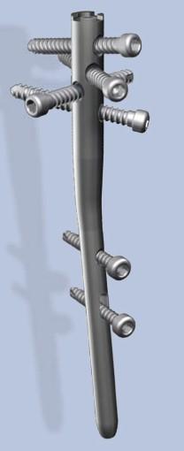 3.3 T2 TM Proximales Humerusnagel System Bei diesem Nagel aus der T2-Reihe der Firma Stryker, handelt es sich um einen 150 mm langes Implantat mit 6 Valgusbiegung aus der Titanlegierung Ti6Al4V (Abb.