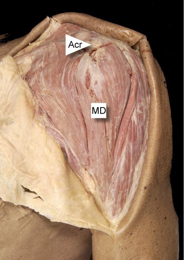 Abb. 18: Situs nach Präparation des Subkutangewebes: links ventrale Ansicht mit M. deltoideus (MD) und Acromion (Acr); rechts dorsale Ansicht, M.