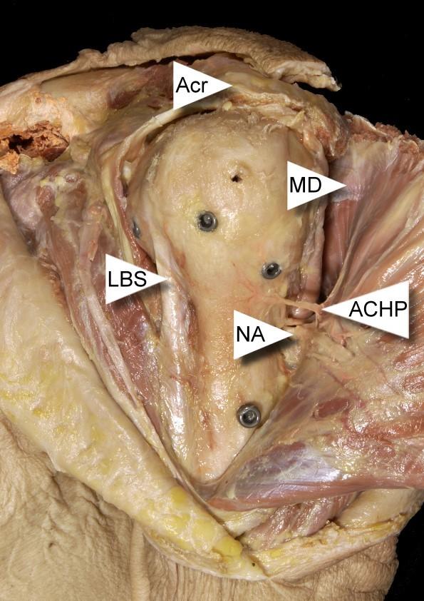 radialis und Arteria profunda brachii (distale Achsellücke) ermittelt. In Region 4 wurde der Abstand der distalsten proximalen Verriegelungsschraube, d.h. Schraubenkopf C des Targon PH bzw.