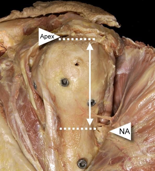 Abb. 20: Links kraniale Aufsicht Humeruskopf mit den proximalen Verriegelungsschrauben A-D bei zentraler Implantation des T2 TM, der Pfeil markiert den Schraubenabstand zwischen C und D; rechts
