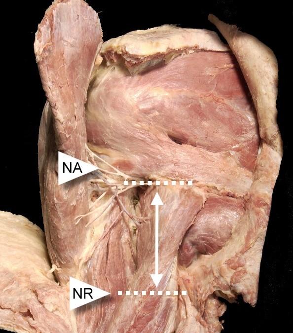 die Distanz zwischen dem höchsten Punkt des Tuberculum majus und dem ventralen Ast des Nervus axillaris (Abb.