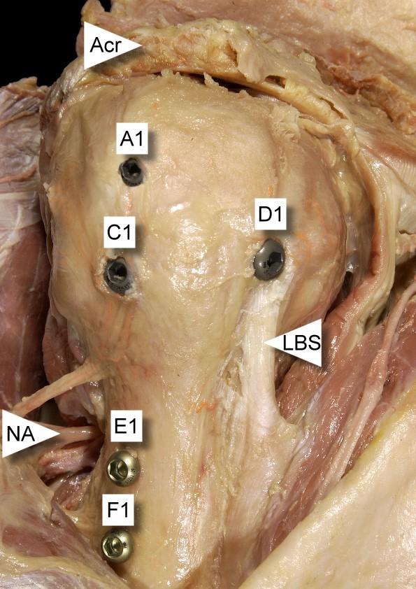 Abb. 24: Schädigung der langen Bizepssehne (LBS) durch die Verriegelungsschraube D1 (Targon PH) Region 2: Deutlichen Bezug zu Nervus axillaris und Arteria circumflexa humeri posterior wies die