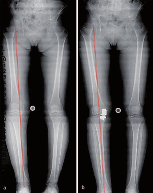 Leitthema des femoralen Knochens die unikondyläre Prothese später ohne größere Probleme in eine bikondyläre Prothese konvertiert werden kann.