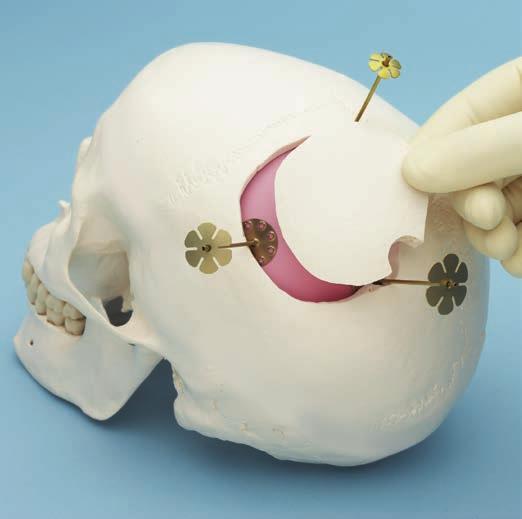 Operationstechnik 3 Den kranialen Knochendeckel einsetzen Den Knochendeckel wieder in seine ursprüngliche Position bringen.