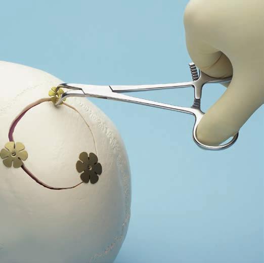 Implantatentfernung Instrument 398.960 Hirschkäferzange, Zahnsperre, Länge 125 mm Mit den Zangenspitzen der Hirschkäferzange zwischen die Blätter des Kleeblatttellers greifen.