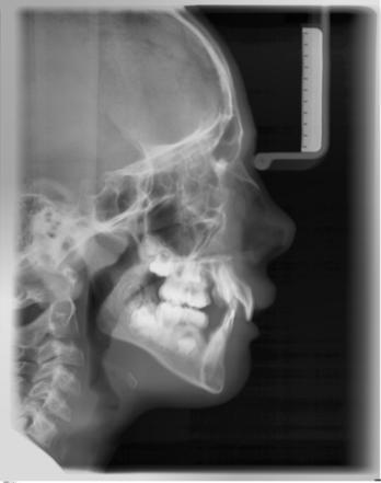 Sirona Dental Systems GmbH 5 Bedienung 5.9.1.3 C3 Aufnahme, lateral Bei dieser Aufnahmetechnik wird eine in die Nasenstütze integrierte Metallskala auf der Röntgenaufnahme abgebildet.