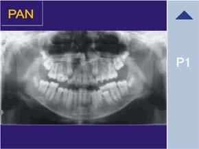 Sirona Dental Systems GmbH 5 Bedienung 3. Lassen Sie die Auslösetaste A los. Die Aufnahme ist abgeschlossen. 4. Prüfen Sie die Aufnahme am Kontroll-Röntgenbild auf dem Touchscreen.