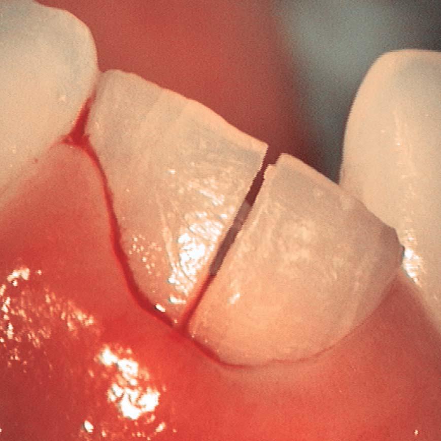 Zahnsituation Occlusale Karies Insuffiziente Füllung Überprüfung der Passgenauigkeit