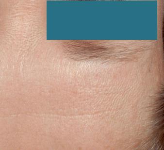 Das Porenverfeinernde Serum gibt der Haut schonend ihren optimalen Zustand wieder zurück, mit sofortiger und lang