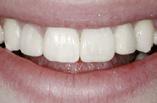Dentinverfärbung, Zahnhalsläsionen 2.