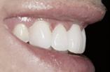 Restaurationstherapie und dem Zahnarzt eröffnen sich