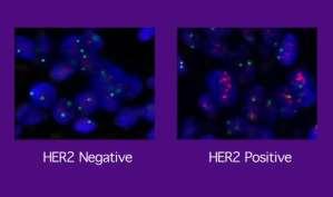 Mammakarzinom - hohes Metastasierungsrisiko ER/PR negativ G3 HER2-neu (3+)