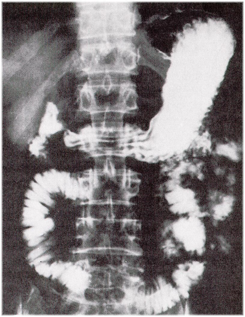 Bildgebende Verfahren Röntgen mit Kontrastmitteln seit 1910 - Bariumsulfat (oral) KM für Untersuchungen des Gastrointestinaltraktes (z.b. Micropaque Flüssig) 100ml (entsprechend ca.