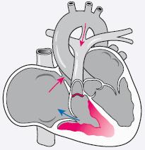 a b c Abb. 5 Rechtsobstruktionen. Bild a: Pulmonalatresie. Blutfluss in die Lungenarterien nur über den persistierenden Ductus arteriosus Botalli oder ein persistierendes Foramen ovale möglich.