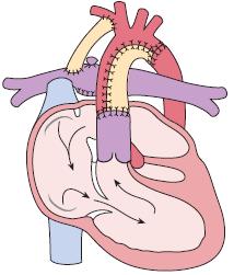Bild b: Double Outlet Right Ventrikel mit Ventrikelseptumdefekt. Sowohl die Aorta als auch die Pulmonalarterie entspringen dem rechten Ventrikel.