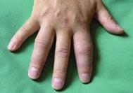Der Finger oder die Zehe sind geschwollen, teilweise auch gerötet und schmerzhaft ( Wurstfi nger / Wurstzehe ).