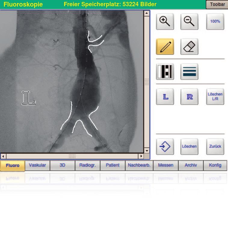 Ziehm Usability Konzept 18 19 Das Anatomical Marking Tool (AMT) ermöglicht dem Benutzer, über den Touchscreen Markierungen und Labels auf Livebilder zu setzen.