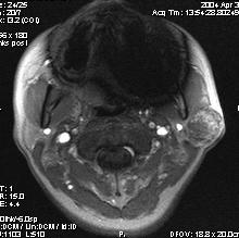 Abbildung 6: Image der dynamischen MRT-Bildgebung eines Patienten mit pleomorphem Adenom auf der linken