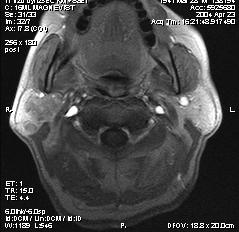 Abbildung 10: Image der dynamischen MRT-Bildgebung eines Patienten mit Warthin- Tumor auf der rechten