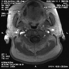 Abbildung 12: Image der dynamischen MRT-Bildgebung eines Patienten mit Morbus Sjögren Abbildung 13: