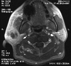 Abbildung 14: Image der dynamischen MRT-Bildgebung eines Patienten mit akuter Parotitis Abbildung