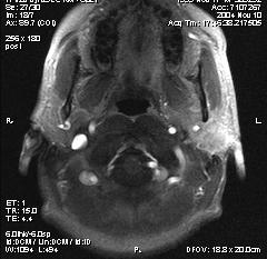 Abbildung 16: Image der dynamischen MRT-Bildgebung eines Patienten mit Mukoepidermoidkarzinom auf der linken