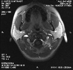 Abbildung 18: Image der dynamischen MRT-Bildgebung eines Patienten mit Mumpsparotitis Abbildung 19: