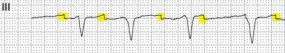 1. Beschreibung des Fehlers Liegt am Eingang ein driftendes EKG Signal vor, wird das EKG Signal durch einen Korrekturmechanismus im Anzeigebereich gehalten.