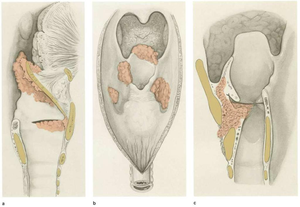 Kurative Laserchirurgie des Larynx und des Hypopharynx a b