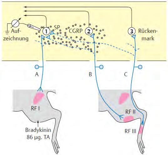 Entrapment nicht-neurale Symptomverteilung entfernte Neuro-Sensibilisierung funktionelle Reorganisation im Spinalganglion (PNS) Hromada 1963 Referred