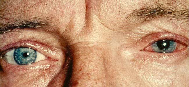 Hochdringliche Augennotfälle Akuter Glaukomanfall = Blockade des Kammerwinkelabflusses mit massiver Augendruckerhöhung Starke einseitige Kopfschmerzen Ich sehe verschwommen und