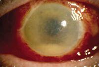 Hochdringliche Augennotfälle Endophthalmitis = (meist bakt) Entzündung aller inneren Augenstrukturen Unmittelbar nach der OP war doch alles gut Jetzt schmerzt das