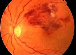 Dringliche Augennotfälle Retinale Venenthrombose Seit heute Morgen sehe ich am