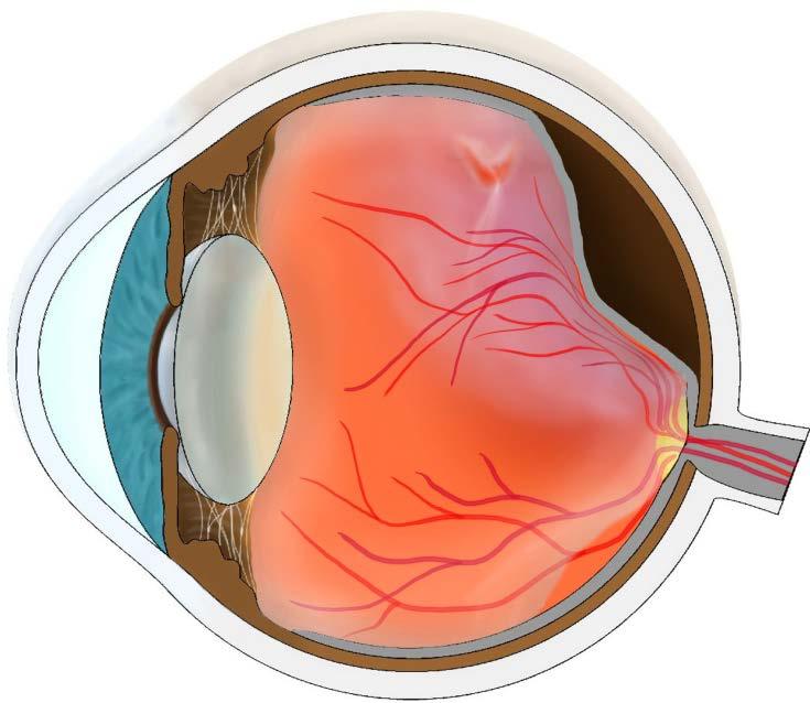 Dringliche Augennotfälle Amotio retinae = Netzhautablösung Plötzlich sehr viele Mouches «Russregen» Fixierter Schatten von peripher zunehmend Mit der Glaskörperabhebung entsteht an Stellen mit