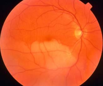 Hochdringliche Augennotfälle Retinaler arterienverschluss Seit heute Morgen sehe ich am rechten Auge nichts mehr Seit dem Mittagsschlaf ist die untere Hälfte dunkel Zentralarterienverschluss: