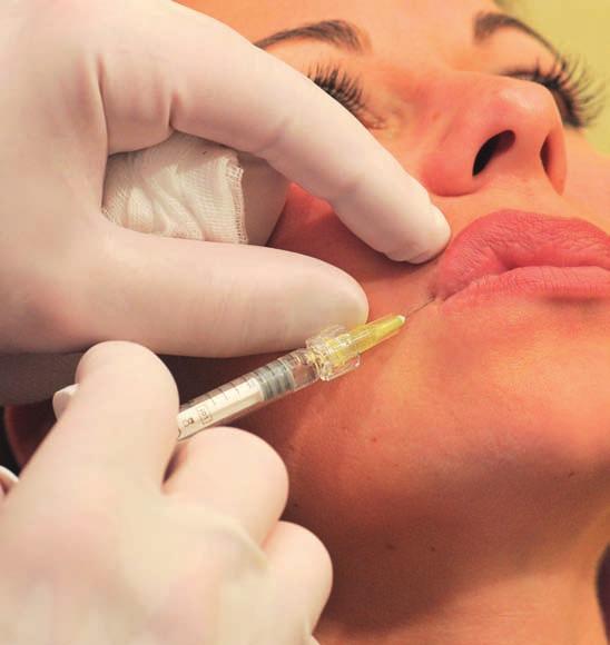 Lippen Behandlung Injektionstechnik 6 Der Einstich erfolgt über der Spitze des Mundwinkels direkt in den Modiolus. Die Stichtiefe beträgt etwa 1 mm.