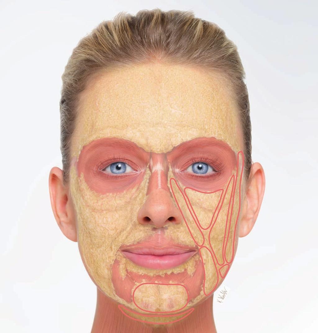 Regionäre Anwendungen Fettpolster die volumengebenden Elemente Das in ein wabenförmiges Bindegewebe eingebettete Fettgewebe bildet die Basis für die Konturen des Gesichts.
