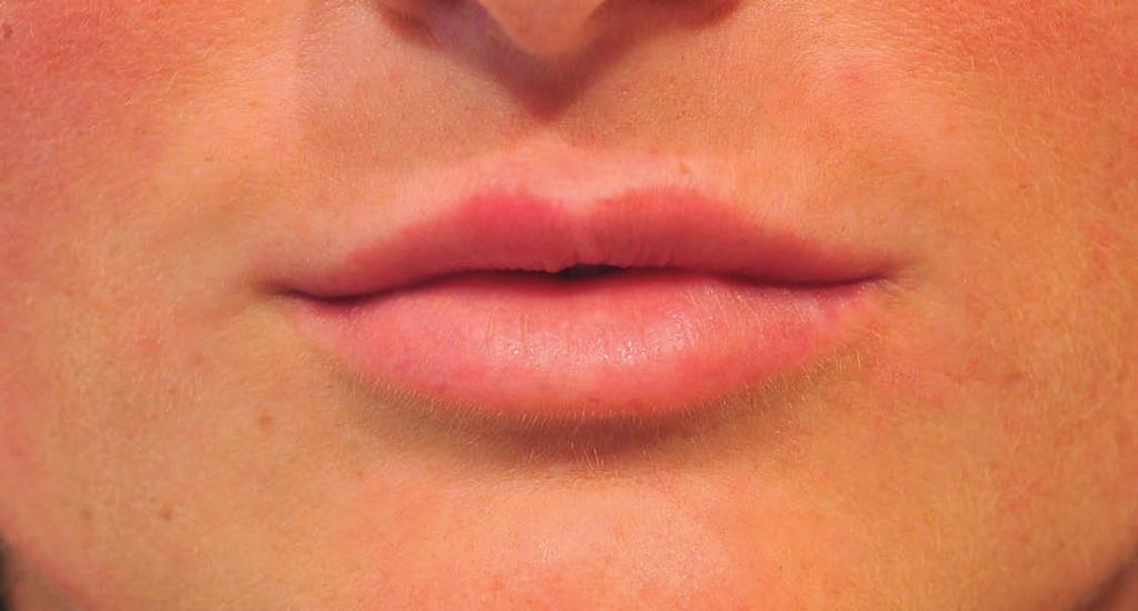 Ausgangsbefund: schmale, etwas asymmetrische Lippen.