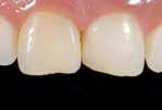 Farbkorrekturen zur Verbesserung der Ästhetik Verblockung, Schienung von gelockerten Zähnen Facettenreparaturen Restauration von Milchzähnen