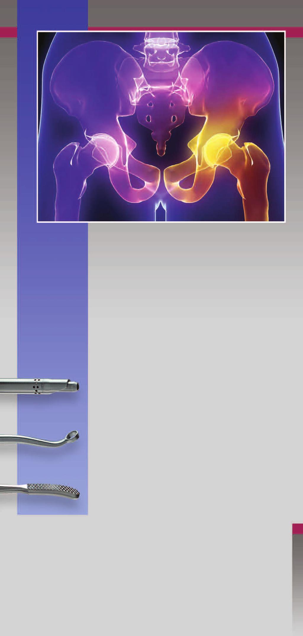 COXARTIS Neues Instrumentarium zur Hüftarthroskopie nach Miehlke COXARTIS ist ein speziell auf die Anatomie des Hüftgelenkes abgestimmtes Instrumentarium zur Hüftarthroskopie.