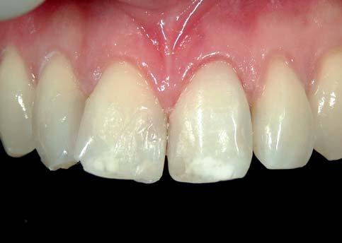 Die Restauration des Zahnes 22 erfolgt nur mit A2E. Auf die palatale Seite des Zahnes 12 wird A2E aufgetragen, gefolgt von A2D zur Ersetzung des Dentins.