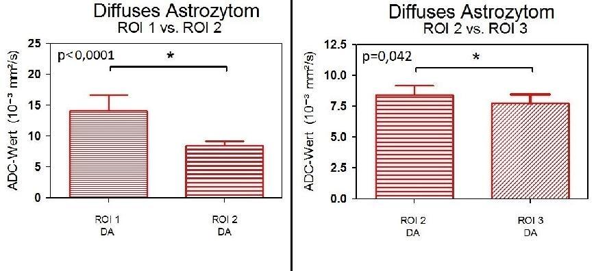 Ergebnisse Abb. 12: Balkendiagramm der ADC-Werte der ROI 1 vs. ROI 2 (links) und ROI 2 vs. ROI 3 (rechts) innerhalb der diffusen Astrozytome.
