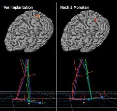 Sie verbessert jedoch nicht nur das Gangbild der Betroffenen, sondern bewirkt auch, dass sich deren Gehirn funktionell neu organisisert.